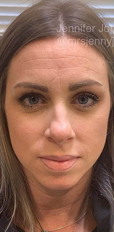 Botox Before & After