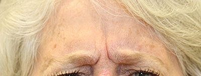 Botox Before & After