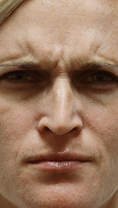 Botox Before & After