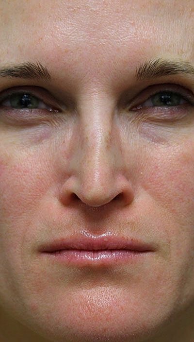 Botox Before & After