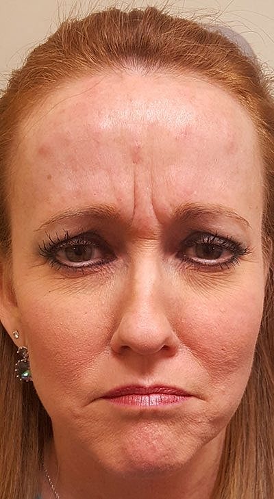 Botox Before & After