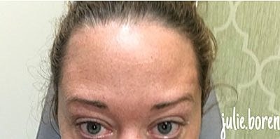 Botox Before & After