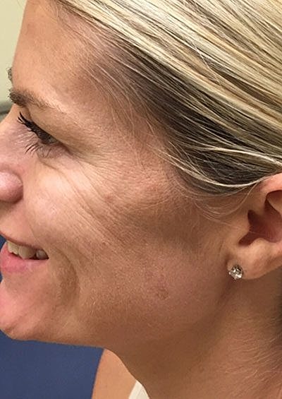 Botox Before & After