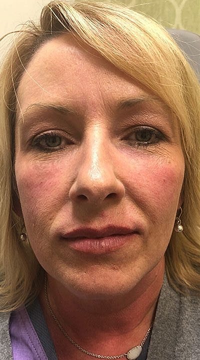 Tear Trough Filler Before & After