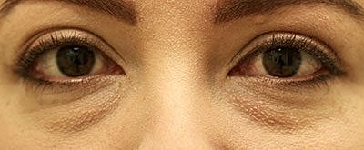 Tear Trough Filler Before & After